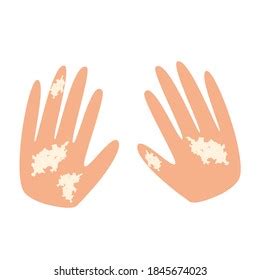 Vitiligo On Hands White Spots On Stock Illustration 1845674023 ...