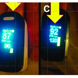 All SpO2 values (on room air) for the 34 severe COVID-19 patients of ...