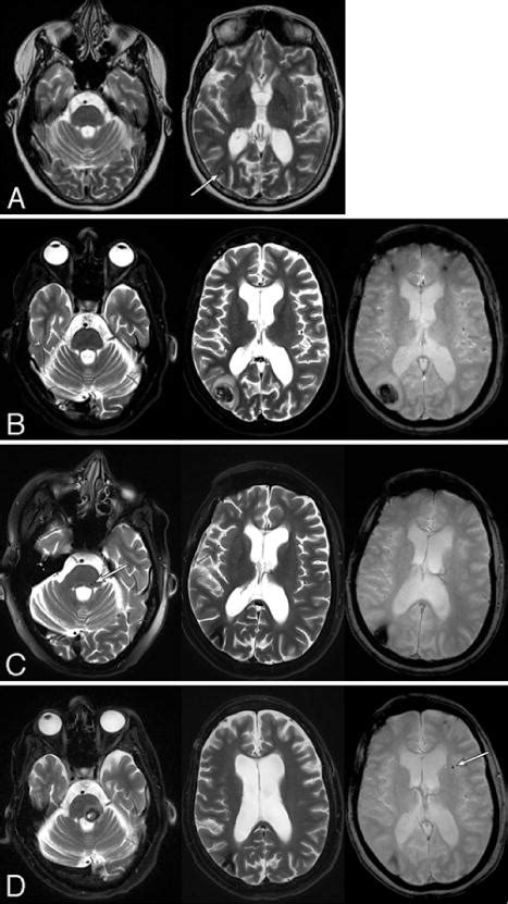 Characterization Of Radiation Induced Cavernous Malformations And