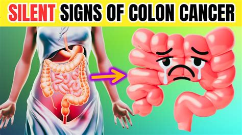 6 Silent Symptoms Of Colon Cancer Key Health Youtube