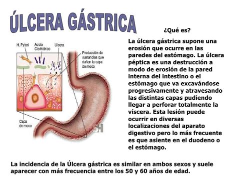 Sistema Digestivo Enfermedades