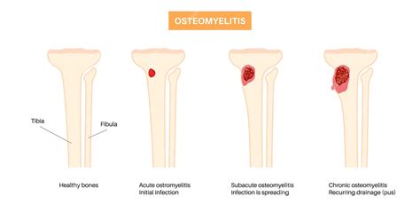 Enfermedad De Osteomielitis Dolor De Huesos Muertos De Rodilla