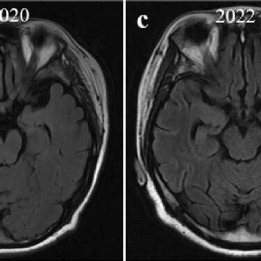 Brain MRI images of the patient in 2014, 2020, and 2022. a, b Brain MRI ...