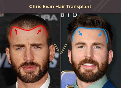 Chris Evans Hair Transplant