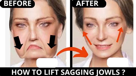 Facial Exercises For Jowls And Marionette Lines Laugh Lines Sagging