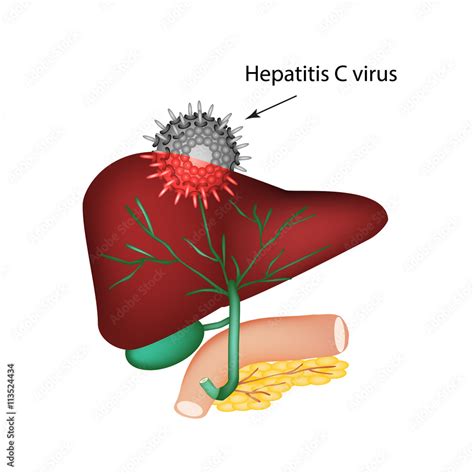 Hepatitis C The Introduction Of The Hepatitis C Virus In The Liver