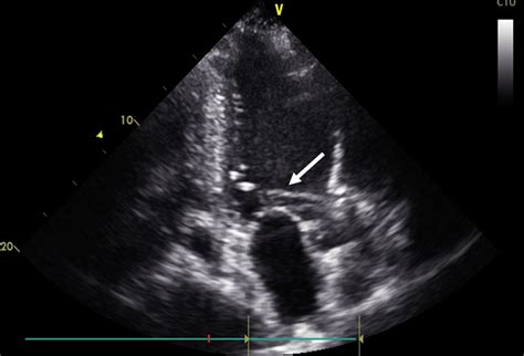 Perforation Of The Anterior Mitral Leaflet After Impella Lp 50 Therapy