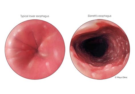 Digestive Diseases News Medical Professionals Mayo Clinic