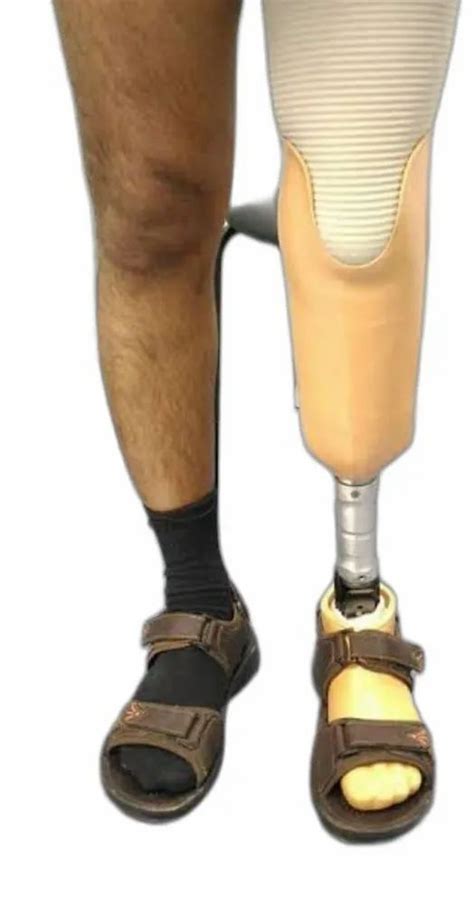 Passive Prosthetic Adult Below Knee Prosthesis Myoelectric At Rs 24000 In Lucknow