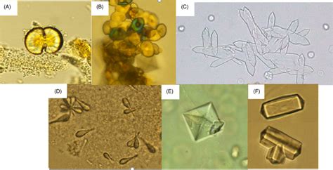 Various Shapes Of Calcium Oxalate Crystals A Dumbbell Shape X400