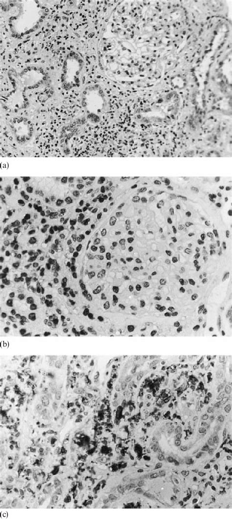 A Renal Biopsy Specimen Showing Moderate Interstitial Fibrosis With Download Scientific