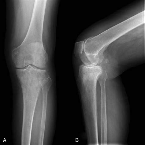 X Ray Radiographs Of The Right Knee Showing The Joint Prosthesis In The