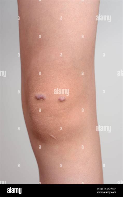 Knee Of A Girl With Keloid Scar Stock Photo Alamy