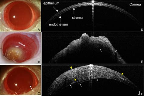 Comparison Of Slit Lamp Pictures To Spectral Domain Optical Coherence