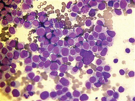 Leukemia Cutis Preceding Bone Marrow Relapse In Acute Monocytic