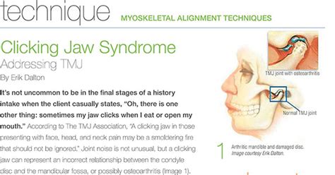 Free Guide: Clicking Jaw Syndrome