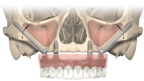 Zygomatic Implants Replace Missing Teeth In Upper Jaw