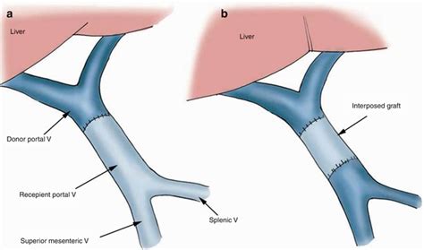 Imaging Of Liver Transplant Radiology Key