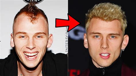 The Difference A Good Hair Transplant Can Make Machine Gun Kelly