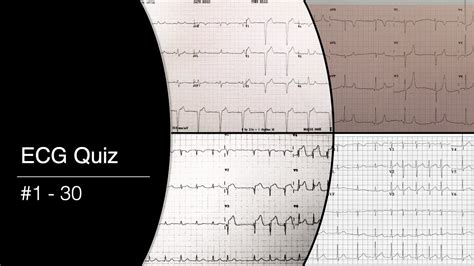 Basic Ecg Quiz With Answers Ecg Quiz With Explanation And