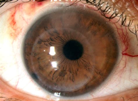 Slit Lamp Photo At The First Postoperative Month Displaced Corneal