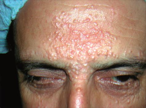 Multiple Apocrine Hidrocystoma Of The Face Treated With A 1450 Nm Diode