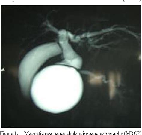 Figure 1 From Episodic Jaundice Due To An Intrahepatic Biliary Cystadenoma With Biliary