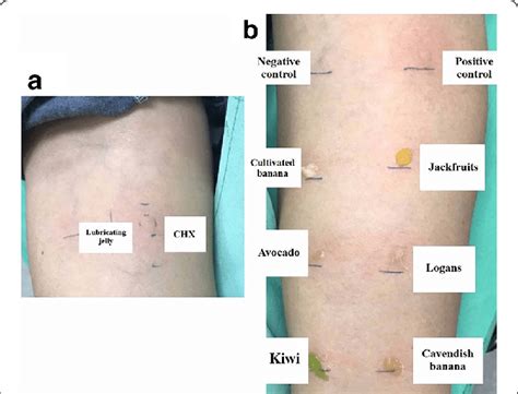 Skin Test Results A Skin Prick Test To Lubricating Jelly And