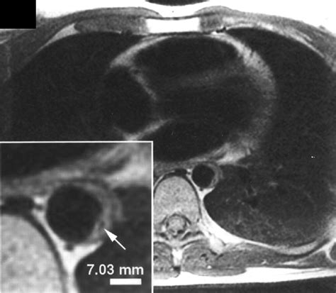 Diagnostic Imaging Of Thoracic Aortic Atherosclerosis Ajr