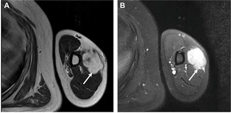 Por Case Report Large Size Intramuscular Nodular Fasciitis A Challenging Histopathologic