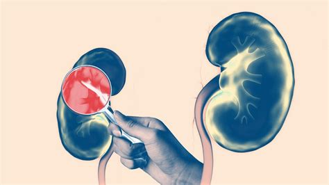 What Are the Most Common Kidney Diseases?