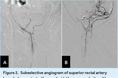 Figure 2 From An Overview Of Endovascular Treatment For Hemorrhoidal