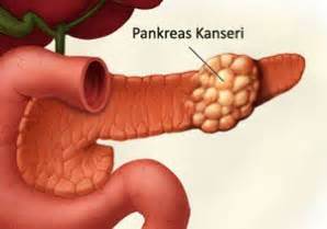 Pankreas Kanseri Nas L Anla L R Nedir Belirtileri Nelerdir Tedavisi