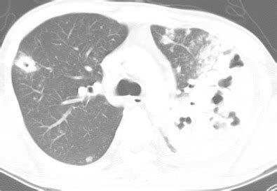 pulmonary tuberculosis radiology key
