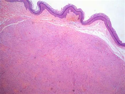 Cutaneous leiomyoma – BosnianPathology