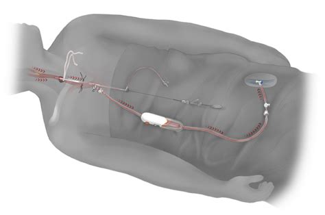 Transcarotid Artery Revascularization Tcar Oaklawn Hospital