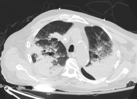 Faces of Pulmonary Hemorrhage | Lungs