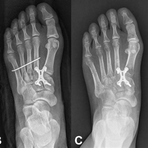 Pdf Short Term Outcome Of Lisfranc Injuries Treated With Single Dorsal Plate Fixation