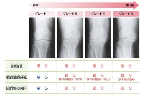 変形性膝関節症 新千歳クリニック 整形外科