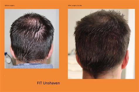 Hair Transplant Without Shaving Head U FUE Classic