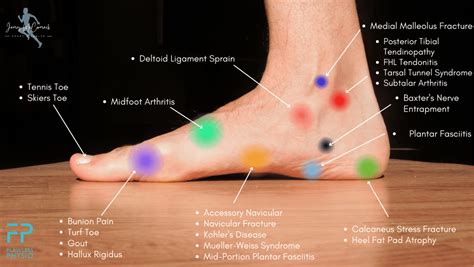 Foot Pain Chart Find The Cause Of Foot Pain With Our Diagram