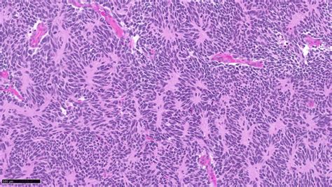 Pathology Outlines Medulloblastoma