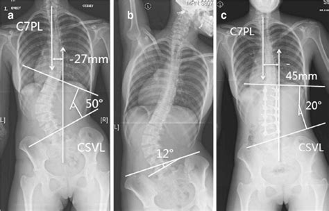 Escoliosis Vertebraeosteopatia