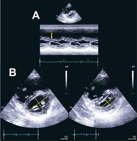 Echocardiographic Patterns Of Abnormal Septal Motion Beyond Myocardial