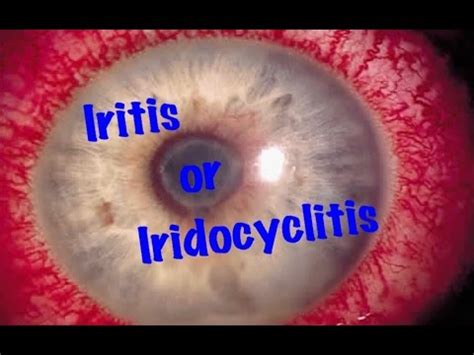 Medical Video Lecture Ophthalmology Iridocyclitis Or Iritis Made