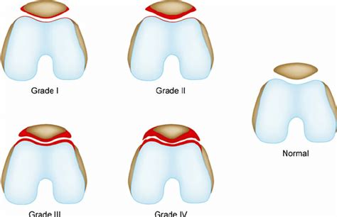 Sperner classification of patellofemoral osteoarthritis: grade 0 (no ...