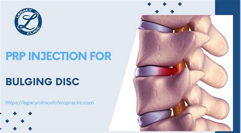 Prp Injection For Bulging Disc Legacy Clinic Of Chiropractic