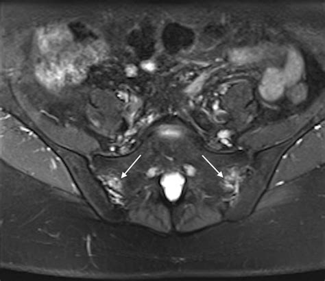 Axial Fat Saturated T2 Weighted Mri Of The Pelvis In A 22 Year Old Man Download Scientific