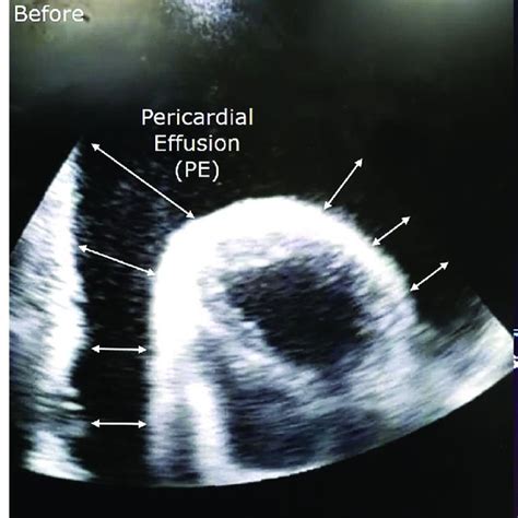 potential sites  echocardiographic guided pericardiocentesis