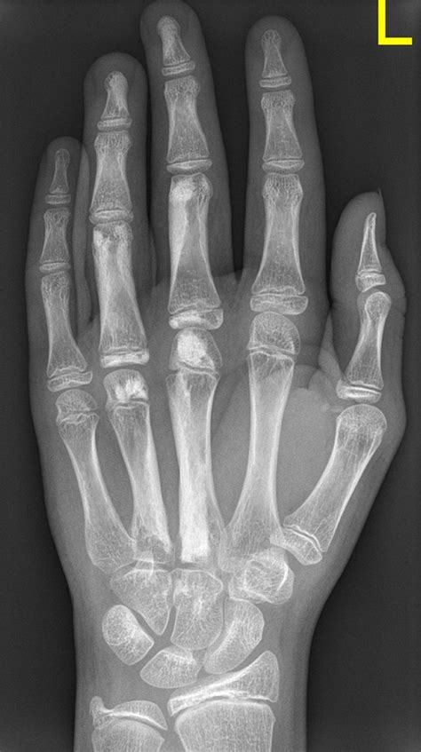 Melorheostosis In The Pediatric Hand Pmc